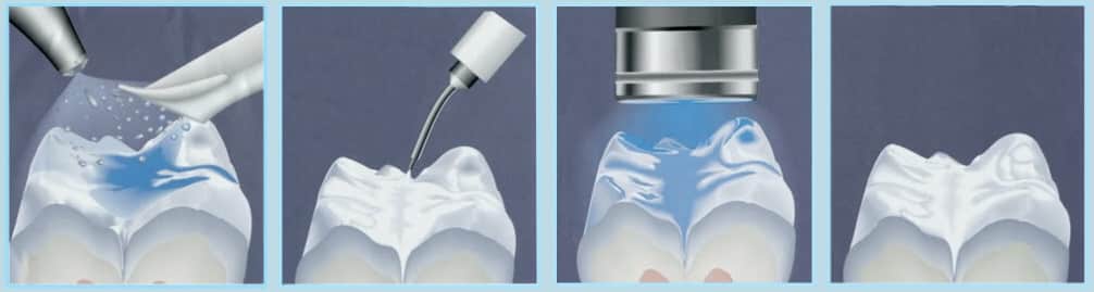 A barázdazárás folyamata. (Kép: Dentalhealth.org)