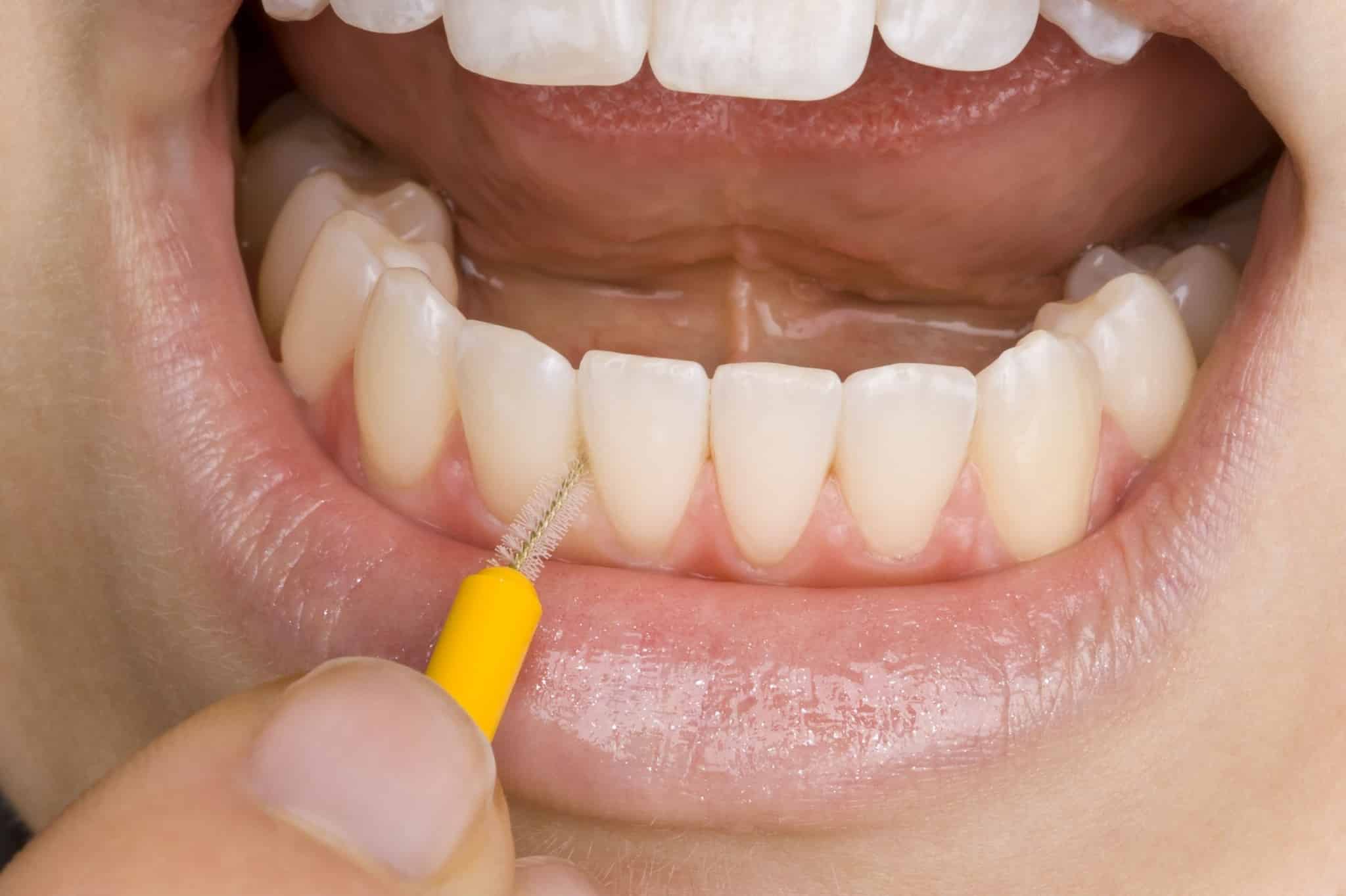A fogközöket fogkefével szinte lehetetlen tökéletesen megtisztítani, erre csak a fogselyem vagy a fogköztisztító kefe alkalmas. /Kép: intimatehealthhelp.net/