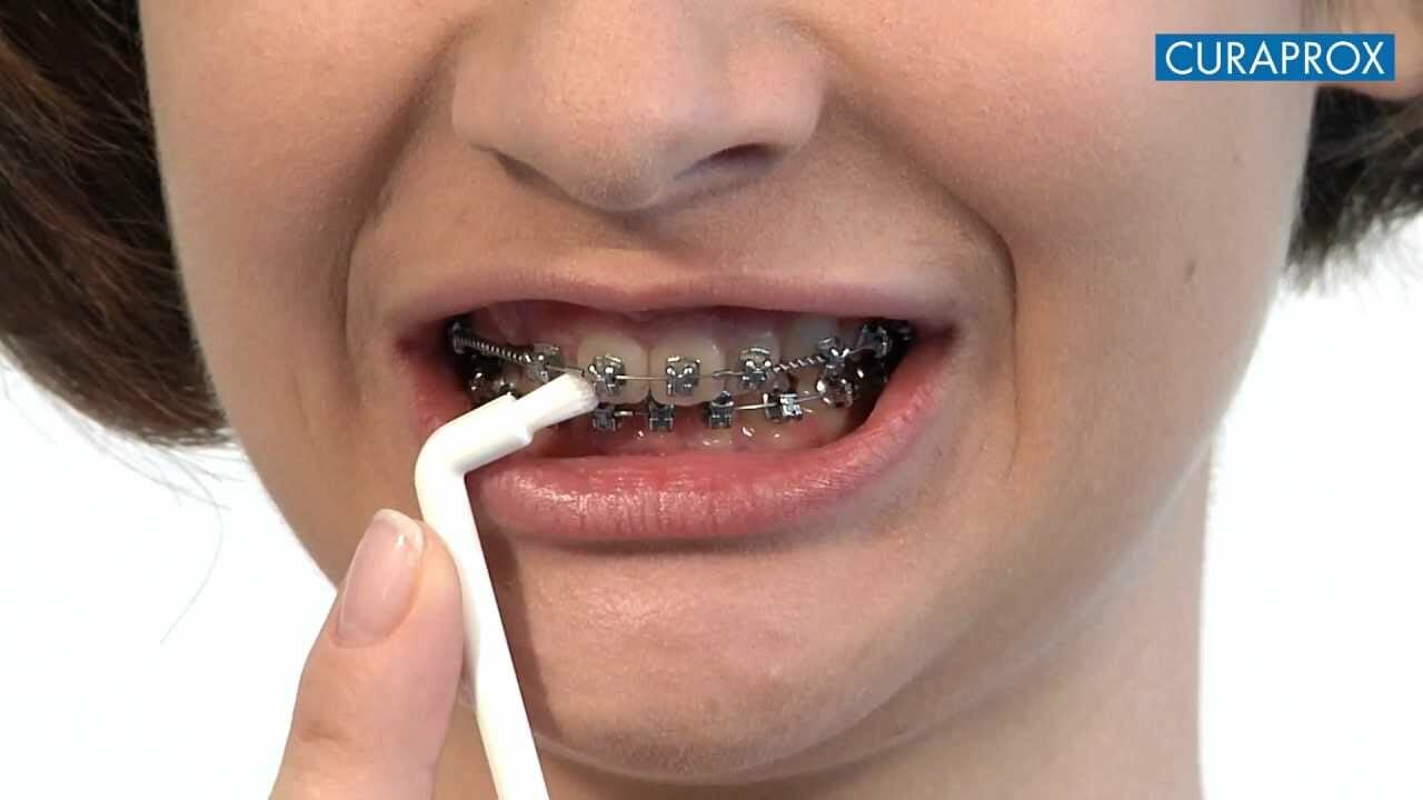 A fogszabályzó és az alatta lévő fogak megfelelő tisztításának kulcsfontosságú eleme az egycsomós fogkefe használata.