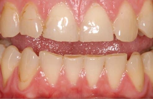 A fogcsikorgatás eredményeként alsó és felső fogsorunk is károsodhat. /kép: Webmd/
