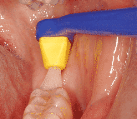 Az egycsomós fogkefével alaposan megtisztíthatjuk a sorvégi fogak nehezen elérhető felszíneit. /Kép: Trolldental.com/