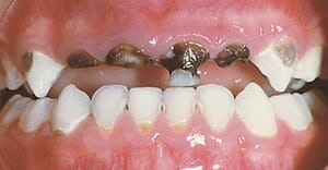 A cumisüveg miatti fogszuvasodás hamar átterjed a szomszédos fogakra is. /Kép: Seasons-of-smiles.com/