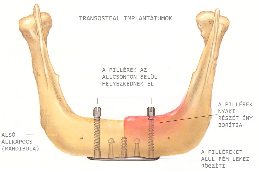Transosteal, vagy csonton keresztüli implantátum. /Kép: Dentalimplants.echc.edu/