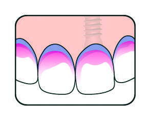 9_3_plaqsearch_teeth