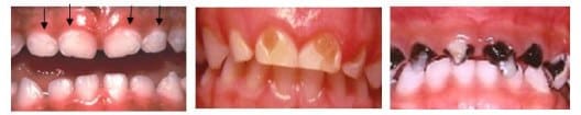 A gyermekkori fogszuvasodás stádiumai (balról jobbra): 1. az ínyszélnél fehér foltok megjelenése, 2. sárgás területek kialakulása, a zománc felületének megbomlása, 3. előrehaladott fogszuvasodás, a zománc nagy részére kiterjedt a betegség. 
