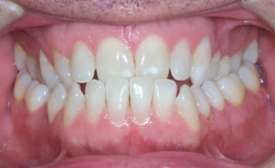 Keresztharapás esetén az alsó fogsor egy része vagy egésze a felső fogsor elé zár. 