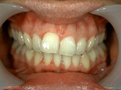 A felső fogsor középvonala és az alsó fogsor középvonala nem egymás alá esik. /Kép: Forthvalleysmiledesign.co.uk/