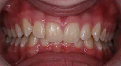 Mélyharapás - a felső fogsor túlságosan rálóg az alsó fogsorra. /Kép: Snoringmouthpieceguide.com/