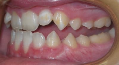 Oldalsó nyitott harapás: a front fogak összezárnak, míg a szemfogtól a rágófogakig egyáltalán nem érnek össze a fogak. /Kép: Windsorsmilesortho.com/