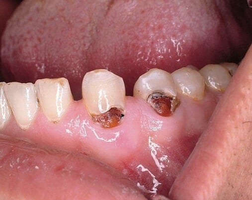 Fognyaki szuvasodás az alsó fogsoron. /Kép: Dentalaegis.com/