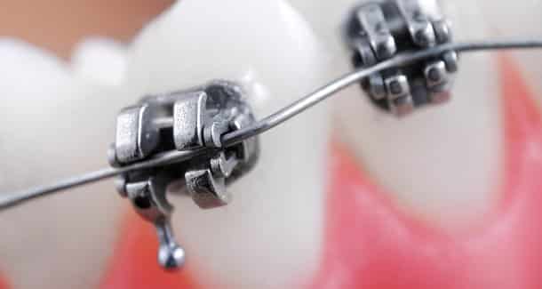 A rögzített fogszabályzó környezetében erősebb a plakk felhalmozódás. /Kép: Dental-tribune.com/