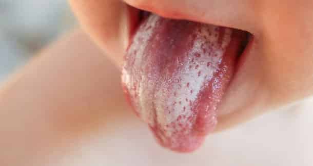 A Candida albicans gombafaj miatti szájpenész gyakori panasz kisgyermekeknél. /Kép: Dental Tribune/