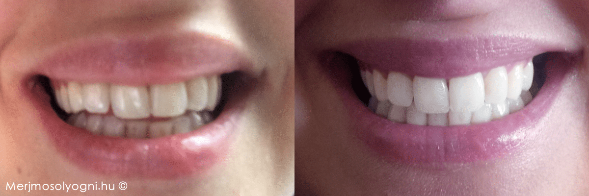 WhiteWash fogfehérítő kúra előtt és után (eredeti képek).