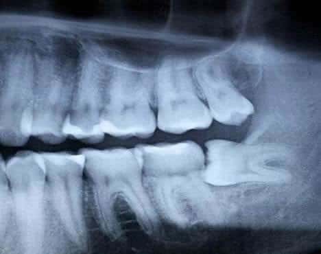 Mitől alakul ki a foghúzás utáni csonthártyagyulladás