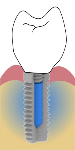 Belső tartállyal (kék terület) ellátott fogászati implantátum. /Kép: Leuven Egyetem/