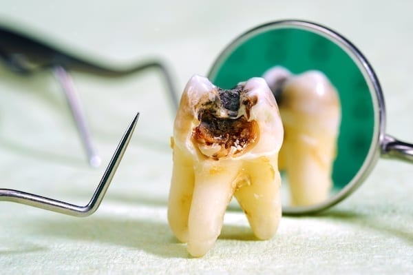 fogszuvasodás okoz e fogyást dexatrim felülvizsgálja a fogyást